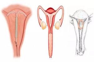 晋江绝经取避孕环(绝经取环好取吗)