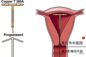 晋江取节育环后(取节育环后怀孕影响孩子吗)