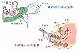 晋江宫腔镜无痛取环多少钱(宫腔镜取环和无痛取环的区别)