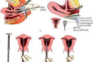 晋江取环后如何避孕(取环后怎么备孕最快)