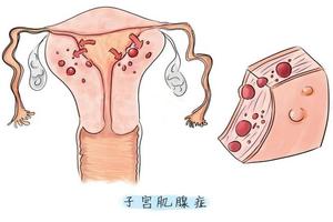 晋江妇科腺肌症(妇科腺肌症有什么症状)