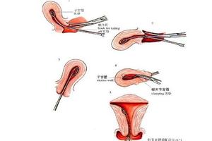 晋江取环去计生办还是医院(取环去计生办还是医院好)