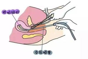 晋江药流人流的价格(晋江做人流的好医院)