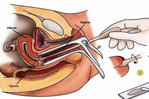 晋江妇科刮片(做妇科刮片什么流程)