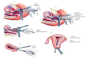 晋江药流 刮宫(药流清宫手术多少钱)